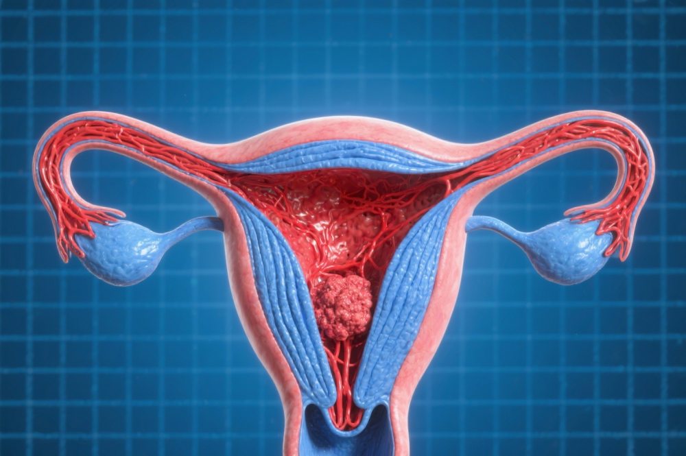 Cancer Treatment in Palanpur